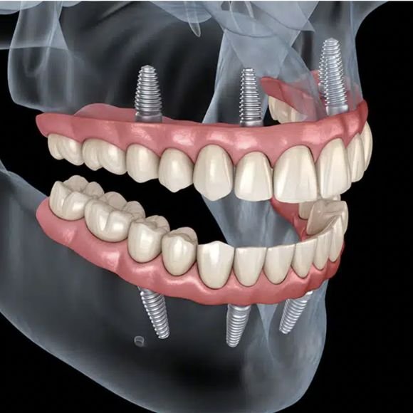 Tratamientos de Rehabilitacion Oral en Bogota - Dr Carlos Castro