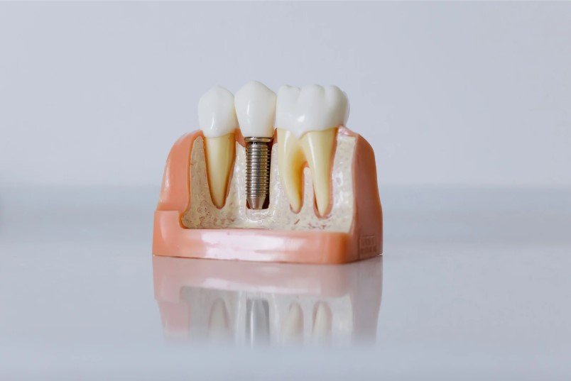 Tipos de implantes dentales